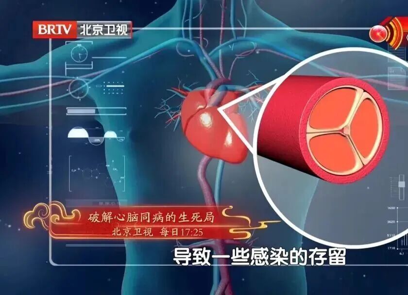 它是动脉硬化 “加速器”！伤心脏、毁大脑，这6类人更危险