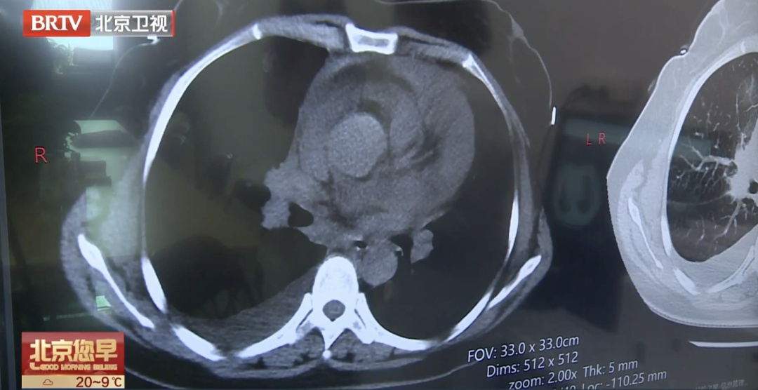 不吸烟，没症状，一查就是肺癌晚期？医生：这几类人每年都要查！