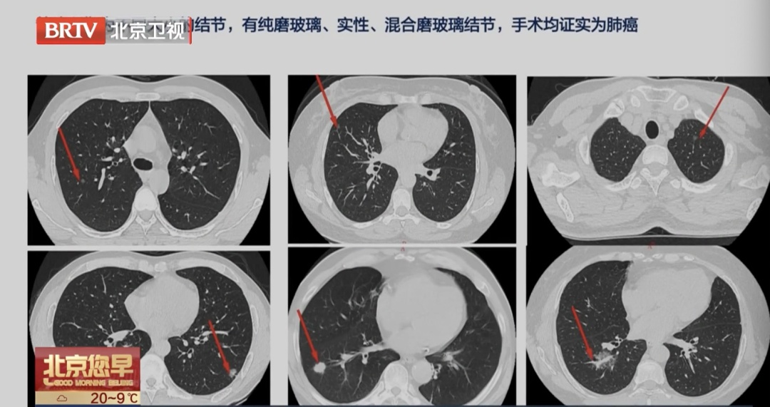 不吸烟，没症状，一查就是肺癌晚期？医生：这几类人每年都要查！