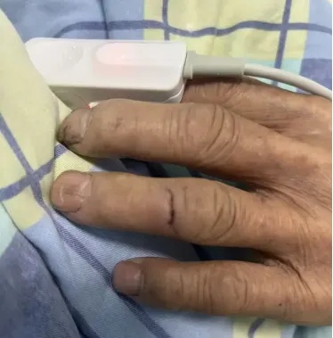 一男子被老鼠咬后确诊鼠咬热，医生紧急提醒