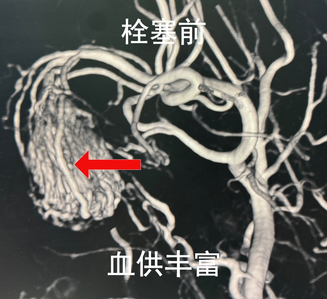 17岁少年鼻塞3年，反复流鼻血，医生一查：不是鼻炎，是肿瘤！