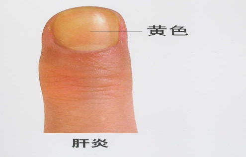 男子手指甲发紫妻子劝他去医院被怼“吃饱了没事干”,几天后老公突然胸痛被120拉走 男子手指甲发紫妻子劝他去医院被怼“吃饱了没事干”,几天后老公突然胸痛被120拉走