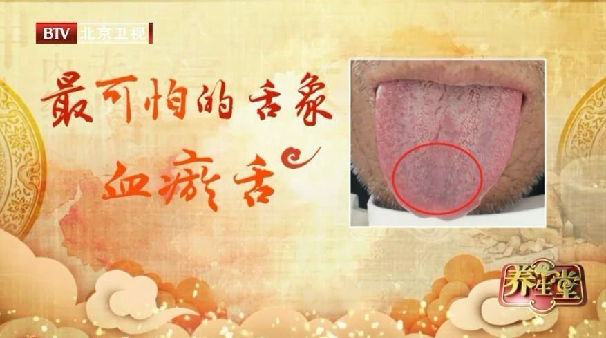 心血管不好的人，舌头会有这种变化！每天一杯羹，化瘀血、护心脏