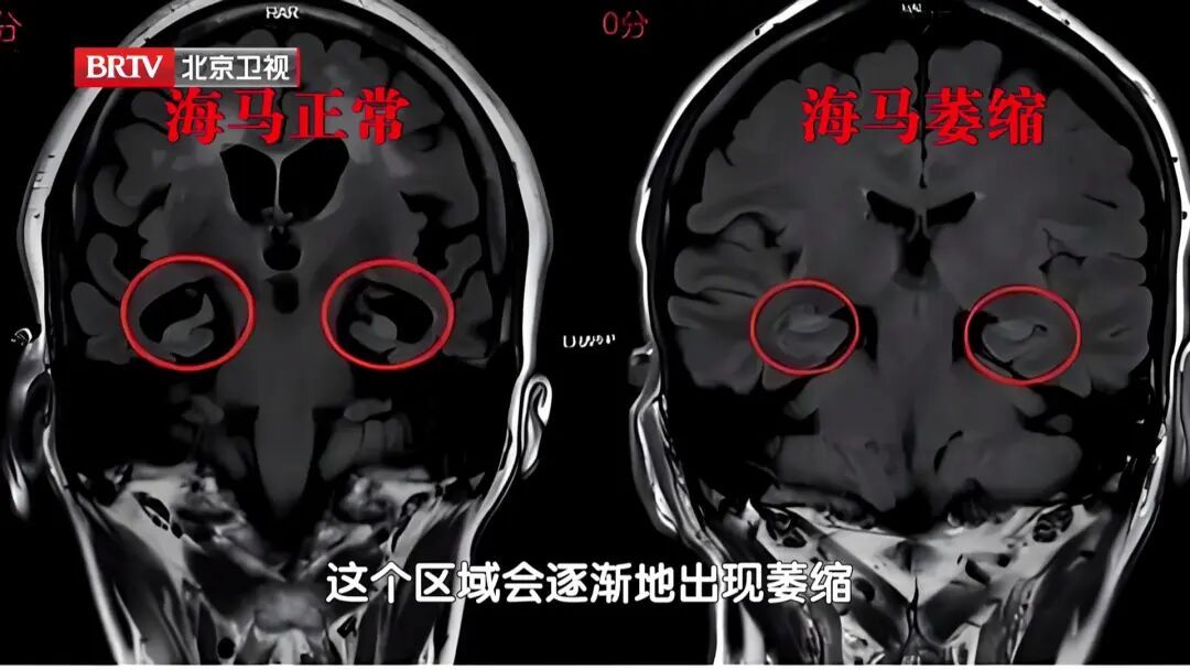 4个晚餐习惯,让大脑变傻、炎症失控、血糖飙升,很多人还天天踩坑 4个晚餐习惯,让大脑变傻、炎症失控、血糖飙升,很多人还天天踩坑