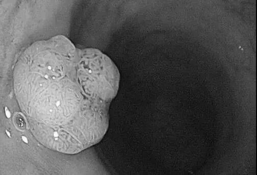 有这22种情况，大概率预示癌前病变，必须做这个检查