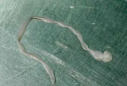 广东一女子脑内取出8厘米长活虫,医生紧急提醒:别再这样吃了! 广东一女子脑内取出8厘米长活虫,医生紧急提醒:别再这样吃了!