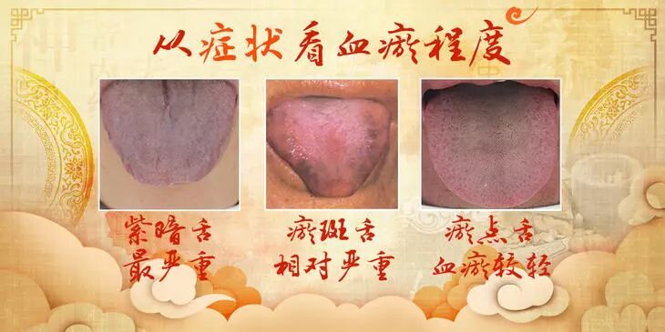 心血管不好的人，舌头会有这种变化！每天一杯羹，化瘀血、护心脏