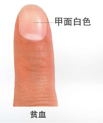 男子手指甲发紫妻子劝他去医院被怼“吃饱了没事干”,几天后老公突然胸痛被120拉走 男子手指甲发紫妻子劝他去医院被怼“吃饱了没事干”,几天后老公突然胸痛被120拉走