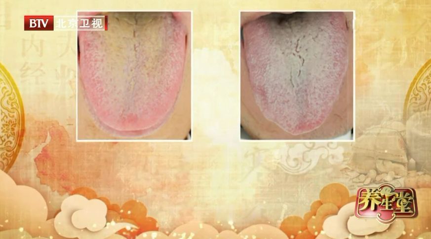 心血管不好的人，舌头会有这种变化！每天一杯羹，化瘀血、护心脏
