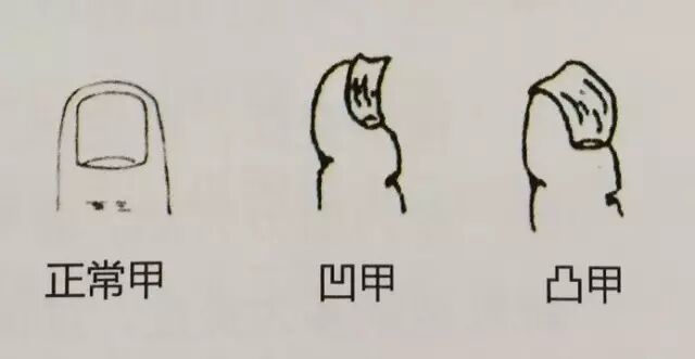 男子手指甲发紫妻子劝他去医院被怼“吃饱了没事干”,几天后老公突然胸痛被120拉走 男子手指甲发紫妻子劝他去医院被怼“吃饱了没事干”,几天后老公突然胸痛被120拉走