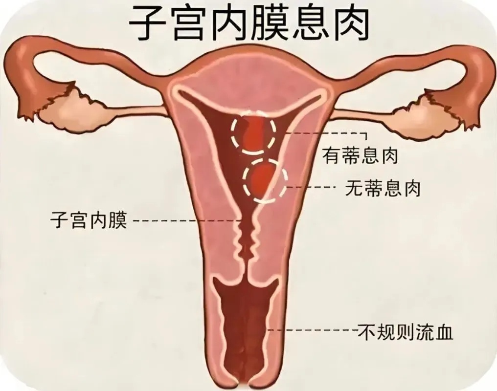 体检查出“子宫内膜息肉”，到底切不切？关键看这项指标