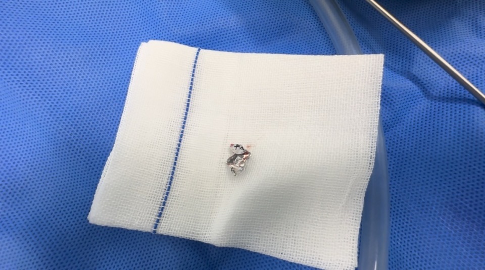 8个月女婴误食花生米大小锡箔纸，医生提醒：喉异物对婴幼儿有致命风险
