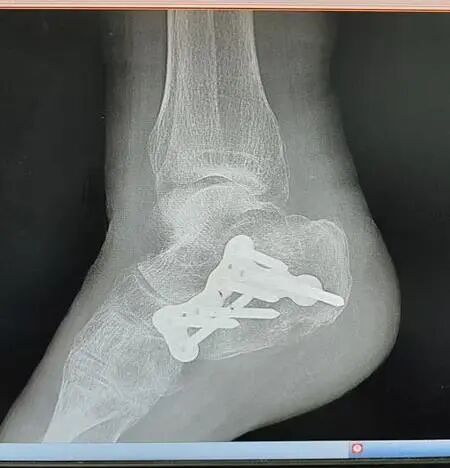 很受伤！75岁上海阿婆一脚踩空，全身多处骨折！公交车“靠站距离”引发争议→