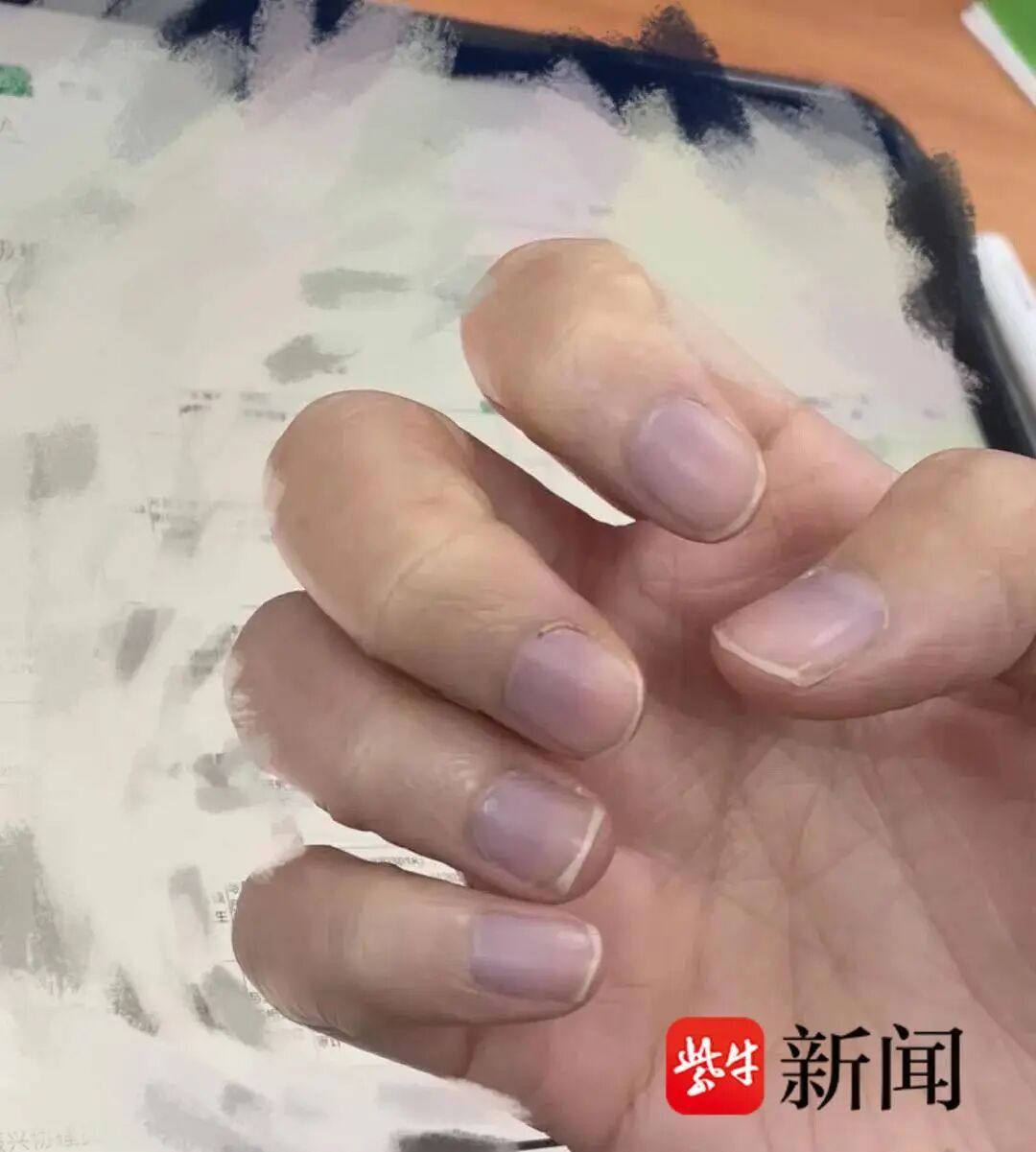 女子发现老公手指甲发紫怀疑心脏有问题，几天后老公就突发胸痛不适！