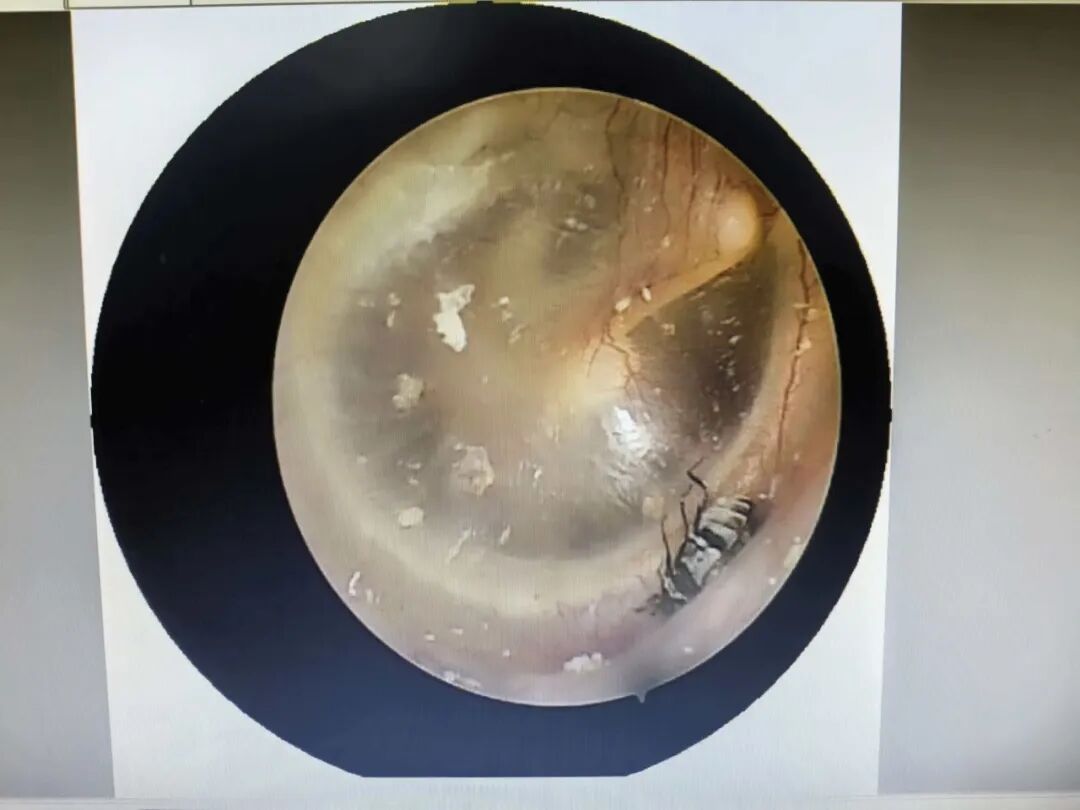 男子半夜耳朵剧痛，像有东西在钻，去医院一查，竟是一只活蟑螂！