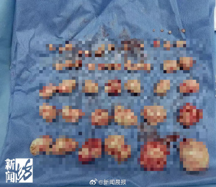 医生都惊了！上海一女子体内取出50颗重6斤子宫肌瘤