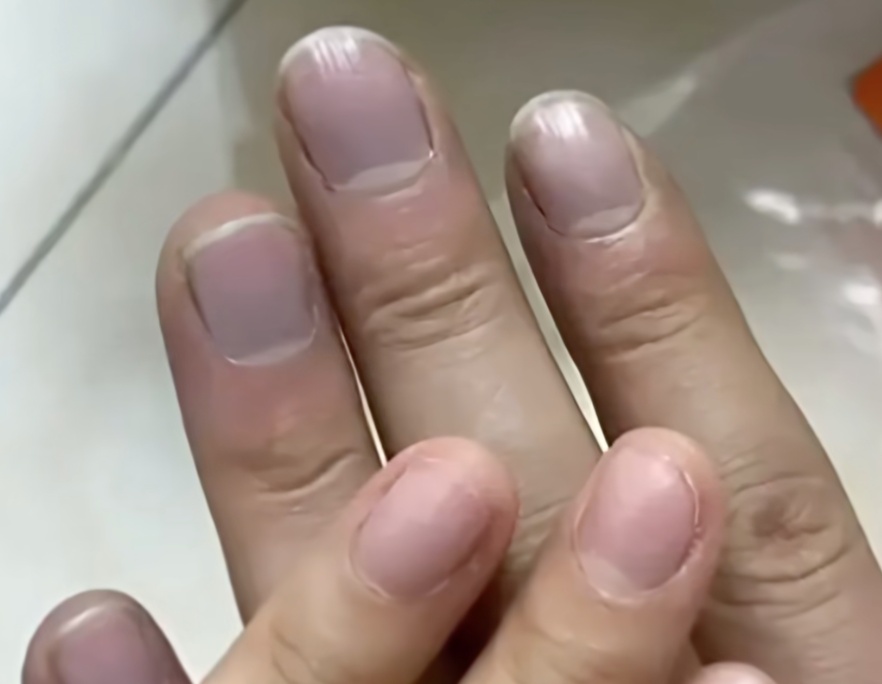 男子指甲发紫拒就医,几天后突发胸痛!这几个信号要警惕 男子指甲发紫拒就医,几天后突发胸痛!这几个信号要警惕