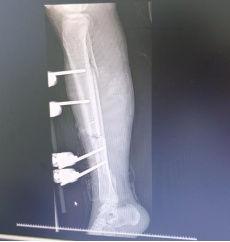 广东44岁女子被工地叉车撞倒,右腿被碾压刺穿几乎完全离断,手术不到3小时腿保住了 广东44岁女子被工地叉车撞倒,右腿被碾压刺穿几乎完全离断,手术不到3小时腿保住了