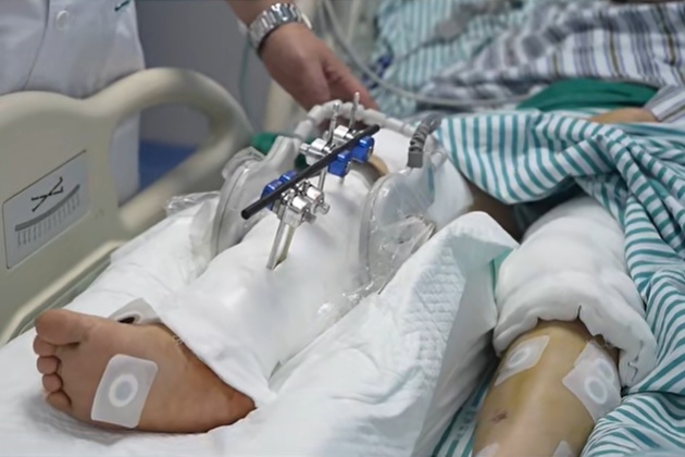 广东44岁女子被工地叉车撞倒,右腿被碾压刺穿几乎完全离断,手术不到3小时腿保住了 广东44岁女子被工地叉车撞倒,右腿被碾压刺穿几乎完全离断,手术不到3小时腿保住了