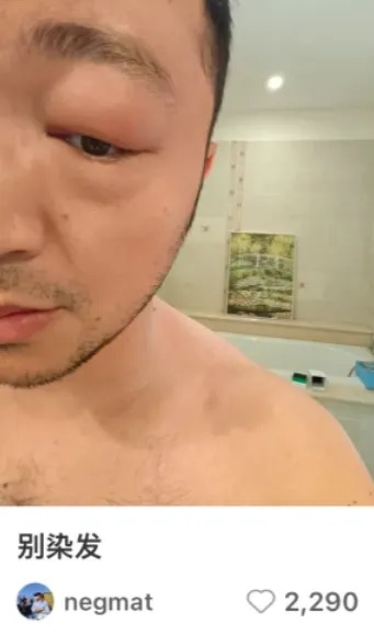 尼格买提晒出自己眼部肿胀的照片并配文：别染发