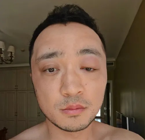 尼格买提晒出自己眼部肿胀的照片并配文：别染发