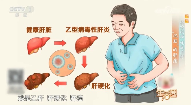 肝不好身体会“说话” 这5招可降低肝癌风险