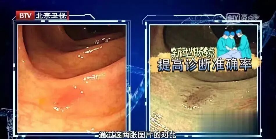 12岁确诊肠癌，元凶竟藏在日常中