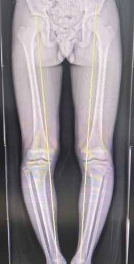 一运动就痛，一定要尽早干预！很多家长都做错了这一步