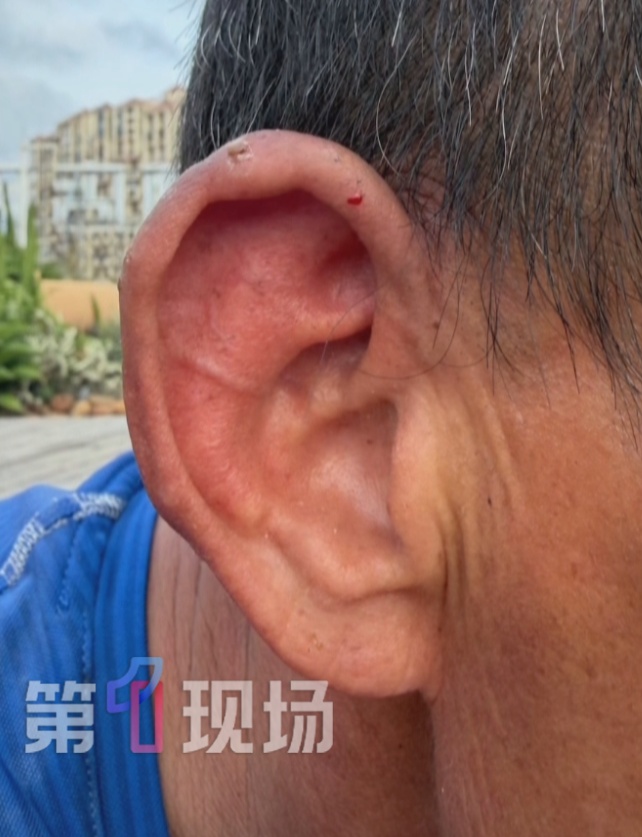 六旬老人看见马蜂窝“上手就干”，两年被蜇伤3次，全身过敏！深圳迎来“高蜂期”