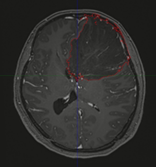 女子头痛恶心持续一个月，颅内查出10cm巨大肿瘤！医生：这些信号可能是大脑在求救