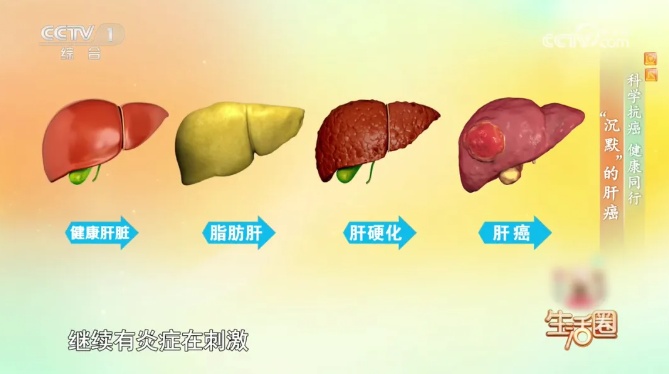 肝不好身体会“说话” 这5招可降低肝癌风险