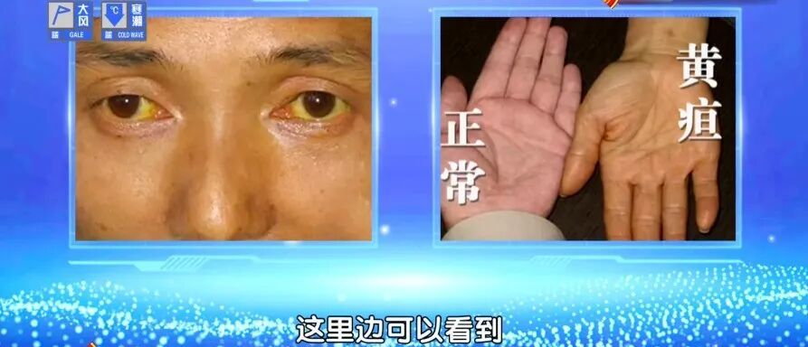 以为是过敏，结果是肝癌，这些伤肝的习惯，很多人天天都在做