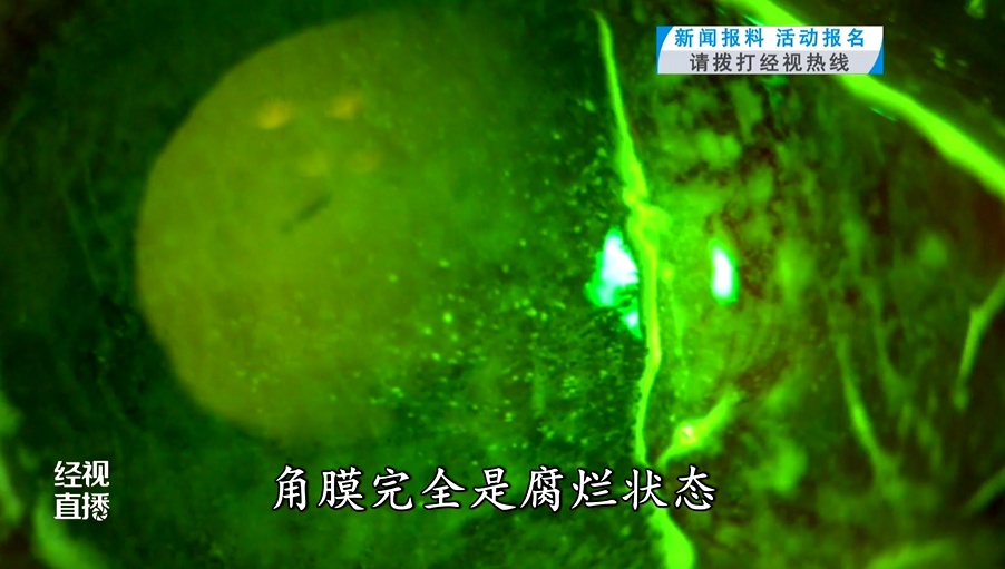 千万不要用手揉！骑电瓶车时飞蚊意外入左眼，福建一男子角膜差点烂穿险失明，医生提醒