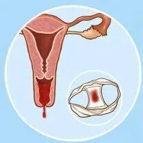 没有性生活，也得宫颈癌？出现这3种异常要警惕→