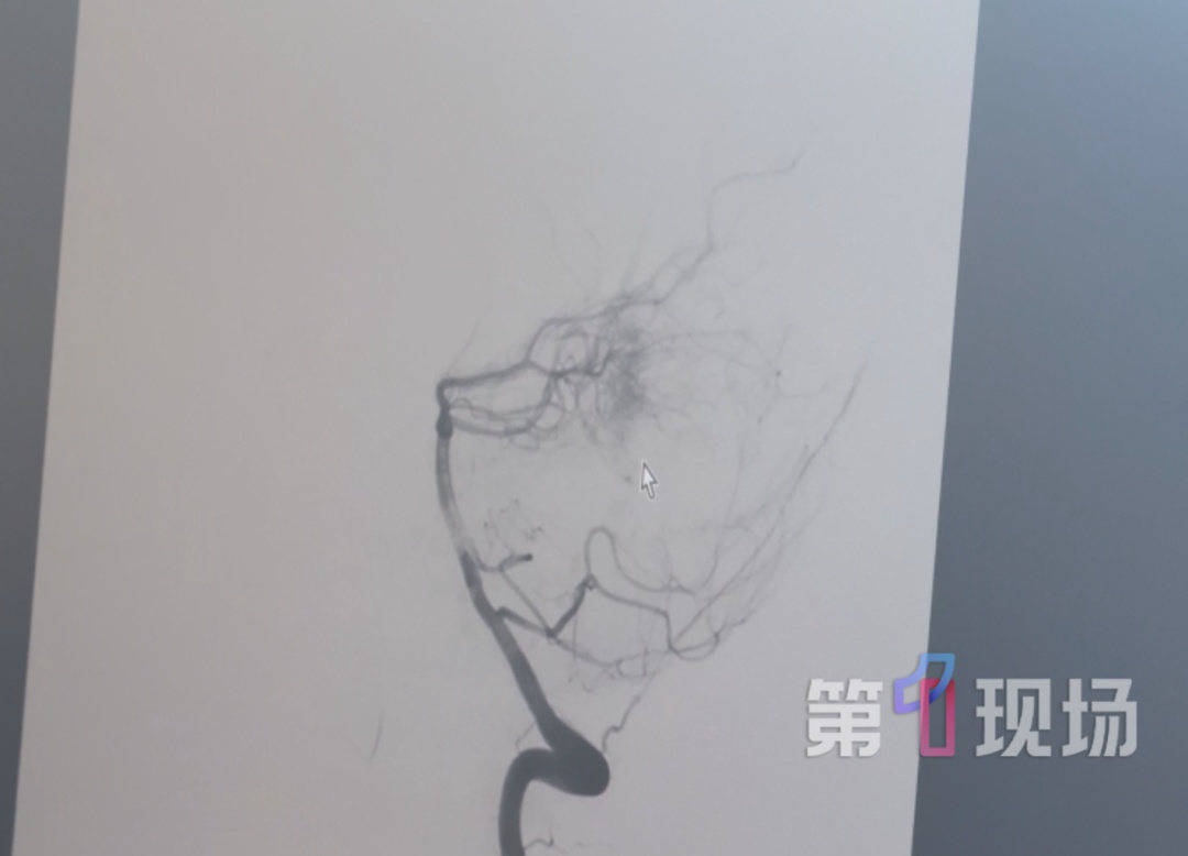 25岁男子健身练背，一使劲儿脑出血了！