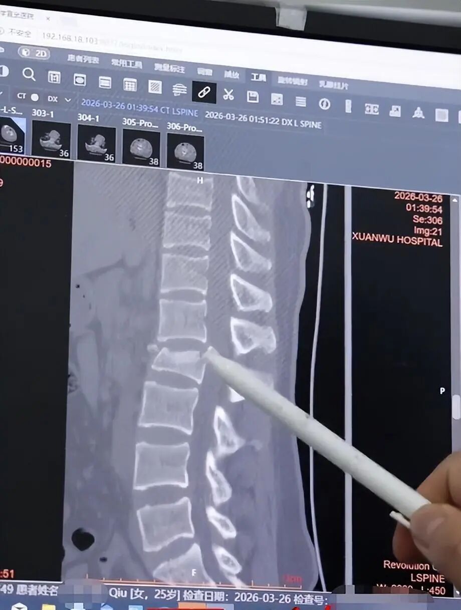 25岁女生下楼梯时玩手机摔倒，腰椎爆裂性骨折，术前下肢瘫痪大小便失禁