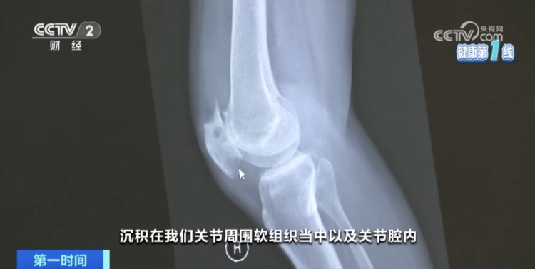 别被“沉默杀手”盯上！快看看体检单上的这个指标