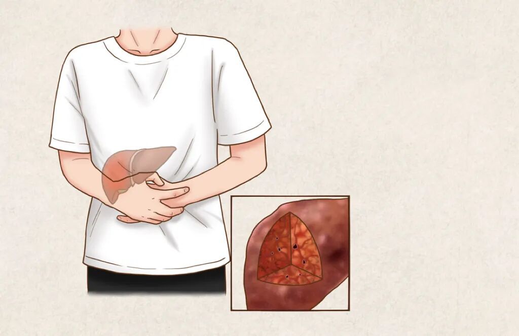 预防肝癌 做好这三点