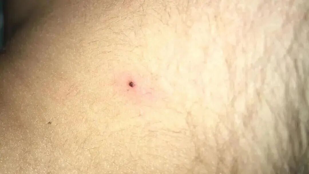 当心！又到一年高发期，身上忽然冒出这种小黑点，要尽快处理，严重可危及生命