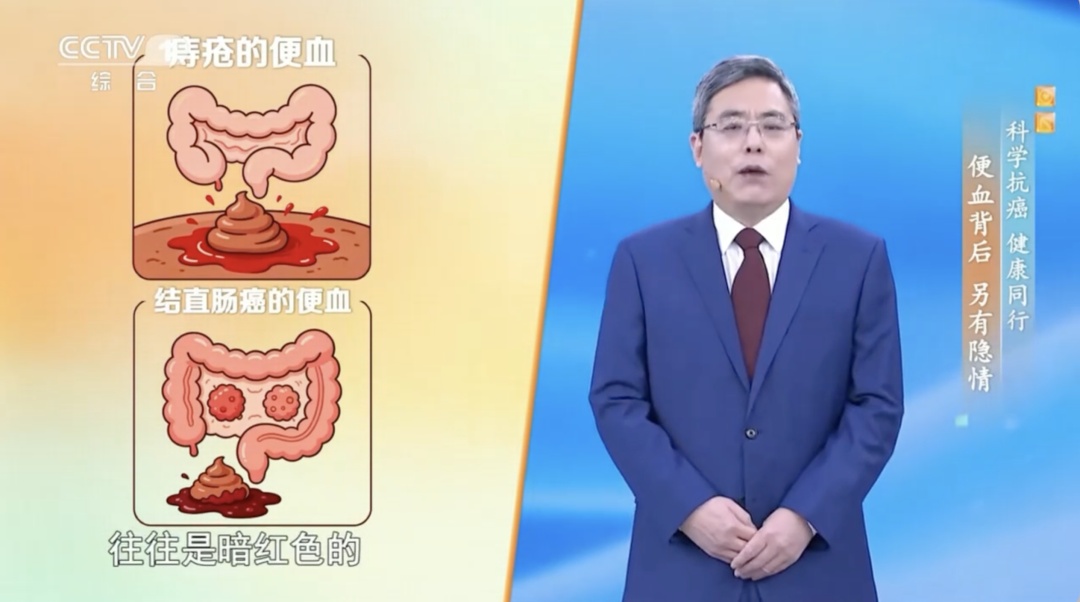 发病率位居恶性肿瘤第2位！别忽视身体发出的“预警信号”，高危人群尤其当心