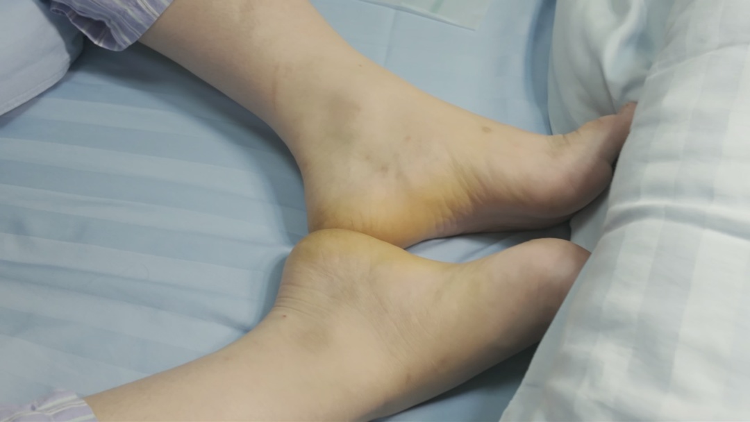 一天一瓶饮料，广州一13岁初中生患上痛风