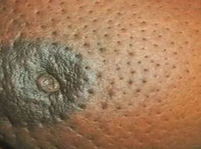 31岁确诊癌症，洗澡时才发现！这种癌症正悄悄“盯上”年轻人……