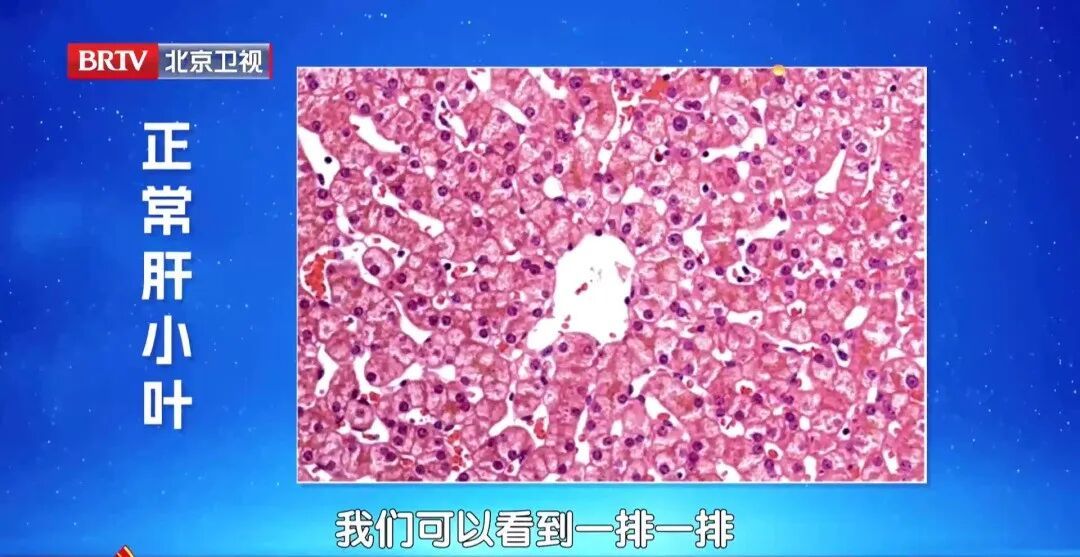 心梗距离猝死仅一步之遥，3招护心、护肝、降风险→