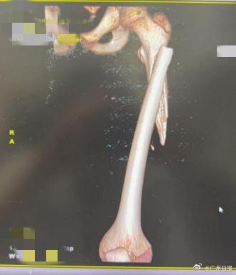 12岁男孩被妹妹推倒后骨折查出肿瘤