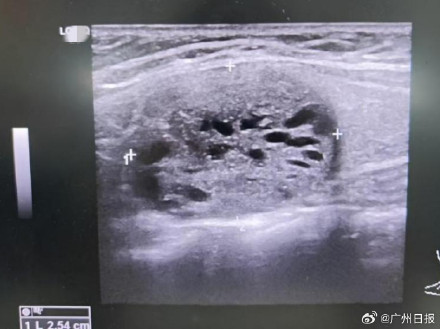 12岁男孩被妹妹推倒后骨折查出肿瘤