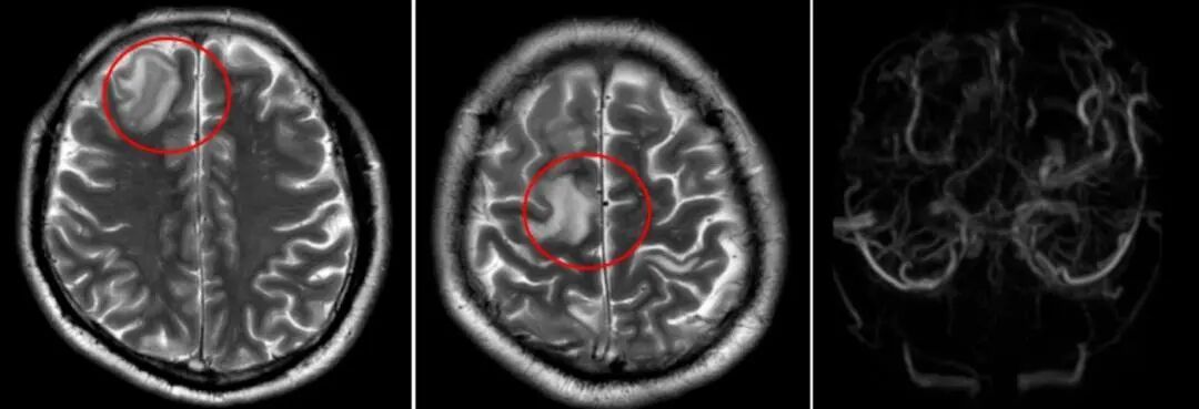 感冒汗蒸 “排毒”？两天汗蒸三次 ，男子脑子“缺水”引发中风