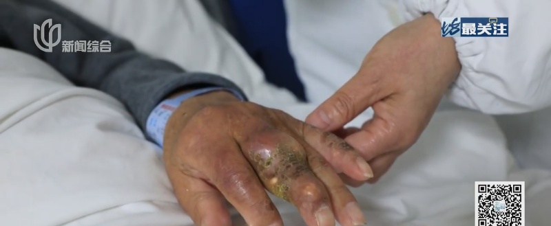 上海38岁男子手指黢黑可怖！有人硬抗30年变尿毒症…超1.8亿人中招