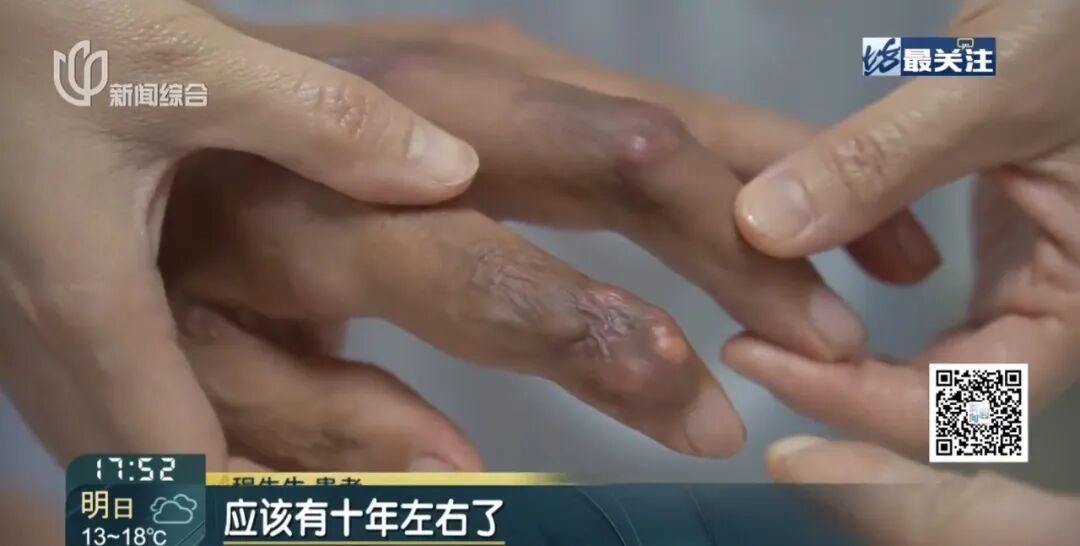 上海38岁男子手指黢黑可怖！有人硬抗30年变尿毒症…超1.8亿人中招