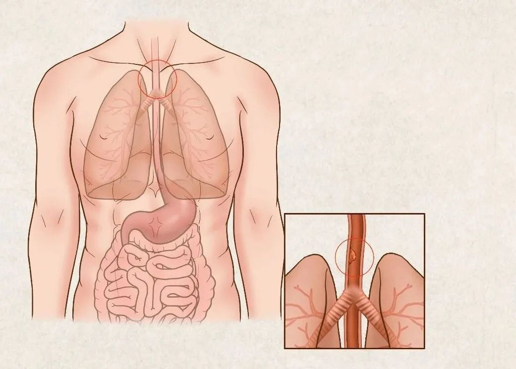 食管癌：被“烫”出来的食管危机