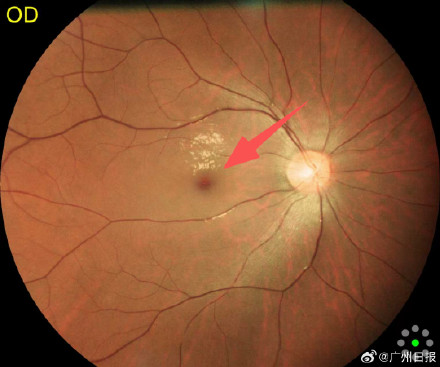 24岁小伙每周四五杯奶茶眼中风突然失明，医生：日常应限制高糖高脂食物摄入量